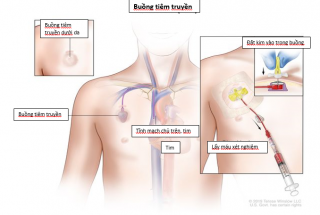 THIẾT BỊ DẪN VÀO TĨNH MẠCH ĐƯỢC CẤY DƯỚI DA (BUỒNG TIÊM TRUYỀN)